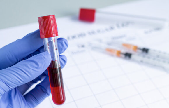 Badania z krwi – jak często powinniśmy je robić?