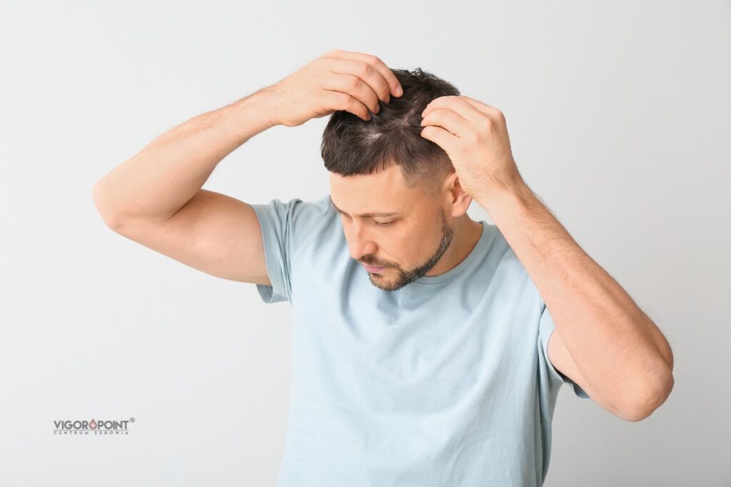 Łysienie - skutki uboczne testosteronu