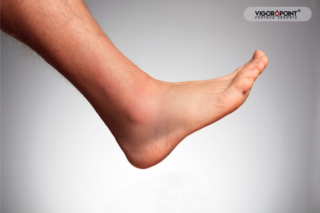 Obrzęknięta stopa.  Skutki uboczne TRT