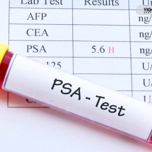 Badanie PSA – męska profilaktyka po 45. roku życia